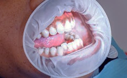 ?懷孕后牙齦出血的癥狀表現(xiàn)