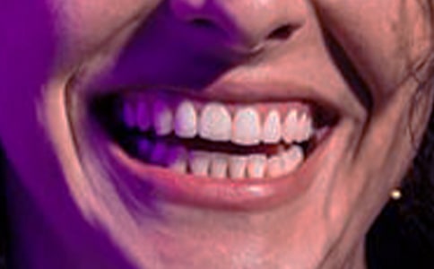 孕婦牙齦出血怎么辦