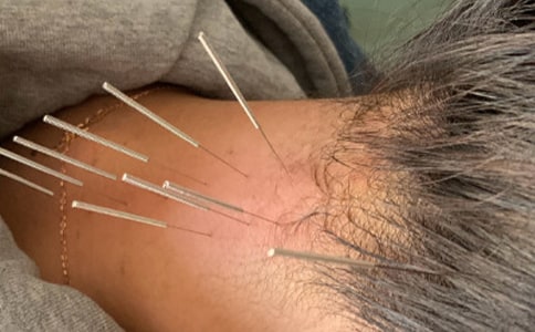 中醫(yī)能治失眠嗎 針灸治失眠