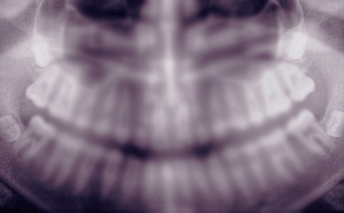 上面的智齒到底好拔嗎